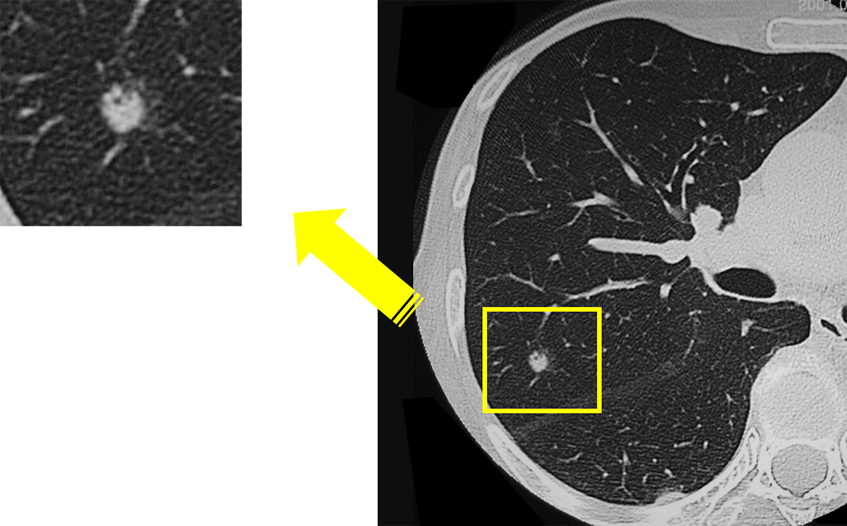早期肺癌（直径8㎜）