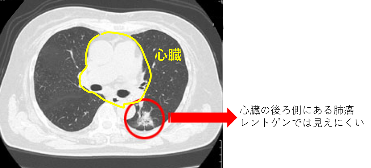 心臓の後ろ側にある肺癌
レントゲンでは見えにくい 